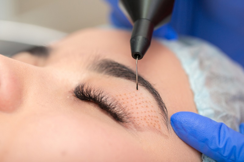 about eyelid surgery