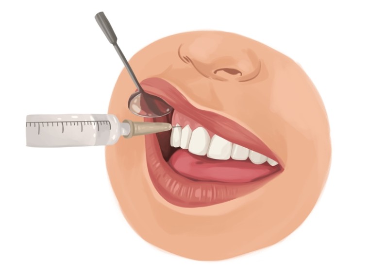 4 Most Commonly Asked Questions About Sedation Dentistry