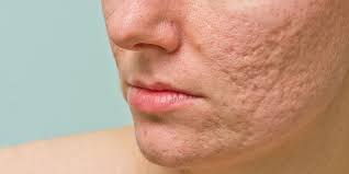 How to Easily Get Rid of Acne Scars With Dermarollers?